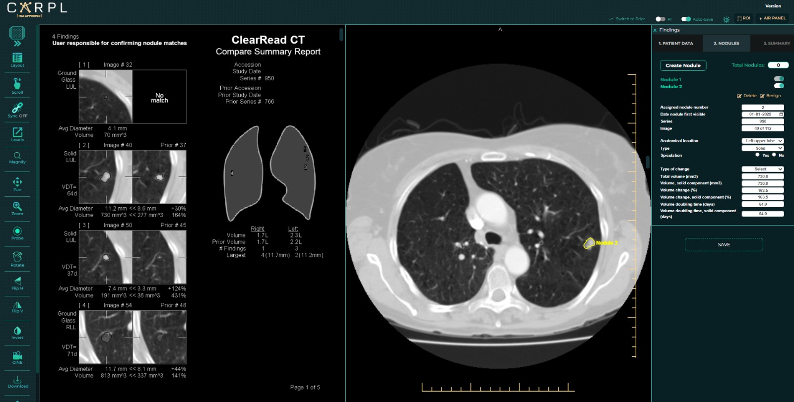 Lung cancer screening radiology AI platform